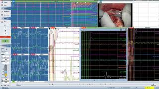 Tumore cerebrale intervento in sicurezza [upl. by Manley501]