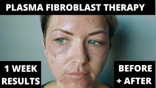 PLASMA PEN FIBROBLAST THERAPY PROCESS  1 WEEK RESULTS BEFORE amp AFTER  SKIN TIGHTENING [upl. by Rebmetpes]