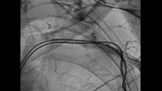 Venous Access in Subclavian Occlusion Micropuncture with Audio [upl. by Anitak350]