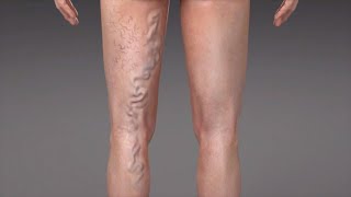 What are Varicose Veins [upl. by Alorac]