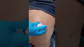 Sebaceous cyst removal rimozione cisti sebacea [upl. by Vyky795]