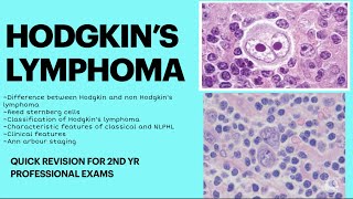 Hodgkin’s lymphoma pathology Quick revision for 2nd yr MBBS pathology examNEET PGNEXT [upl. by Ydok]