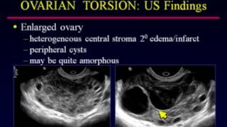 Sonographic Evaluation of Ovarian Torsion [upl. by Kendell759]