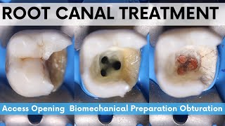 Root Canal Treatment🔵Mandibular 2nd Molar🟡Access Opening🟢 Biomechanical Preparation⚪️Obturation [upl. by Nunnery]