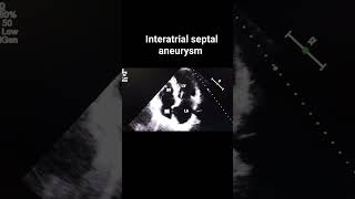 Interatrial septal aneurysm [upl. by Sibyl]