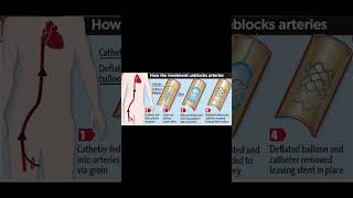 PCI Percutaneous Coronary intervention [upl. by Franzen]