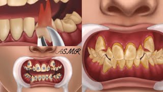 ASMR Dental care and orthodontic installationDental care animation [upl. by Karen]