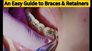 How to fit Braces amp Retainers recommendationssee Detailed Description🇬🇧uk dentist smilebraces [upl. by Kirit243]