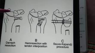 Ulnar sided procedures [upl. by Carleen]