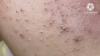 Super blackheads HoangMySpa24 [upl. by Danya]