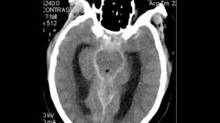 CT Head Subarachnoid Hemorrhage DISCUSSION by Radiologist [upl. by Nnylarej]