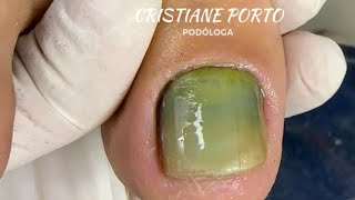 😱 UNHA COM FUNGOS JÁ VIRAM nails ingrowntoenail satisfatório [upl. by Aratahc]