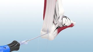 Haglunds Excision and Achilles Reconstruction Using the CuffLink™ System  CONMED Animation [upl. by Durwin]