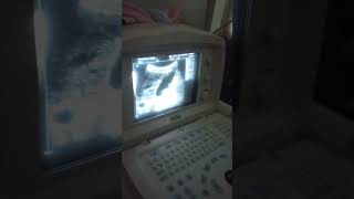 abdominal ultrasound cirrhotic liver cholecystitis with cholelithiasisshortvlog [upl. by Grantland903]