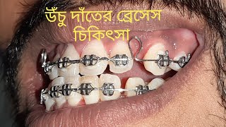 উঁচু দাঁতের চিকিৎসা চলছে। Dental braces treatment of proclined teeth [upl. by Yehtomit]