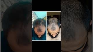 Day1 and day 50 minoxidil hairstyle hairgrowth hairtransformation hairtransplant hairtreatment [upl. by Calley948]