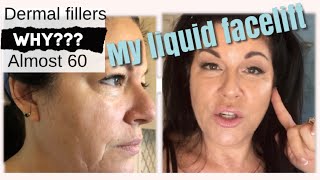 MY LIQUID FACELIFT  BYE BYE JOWLS  DERMAL FILLERS [upl. by Kerwin877]