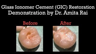 Glass Ionomer Cement GIC RestorationDemonstration by Dr Amita Rai [upl. by Conlon]