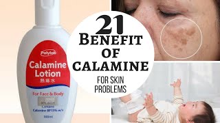 CALAMINE lotion  Lacto calamine lotion uses in detail side effects [upl. by Airdua]