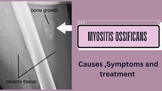 Myositis ossificans [upl. by Drahcir]