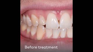 Clinical case Restoration of a lateral incisor [upl. by Yenreit]