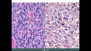 Characteristics neoplasia chap 3 part 6 pathoma [upl. by Ardnasal76]