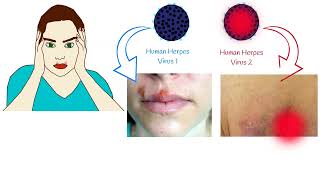 Oral Herpes and Genital Herpes Symptoms and Treatment Herpes Simplex Virus [upl. by Congdon967]