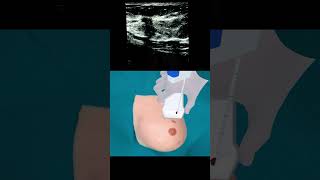 How Breast Biopsy is done 3Danimation [upl. by Griffie797]