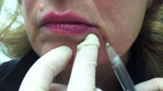 Juvederm for Smile Lines [upl. by Mayfield]