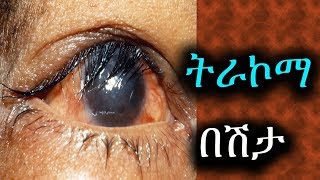 Trachoma trachomatis causes pictures disease prevention meaning 2019 in Ethiopia [upl. by Leelahk]