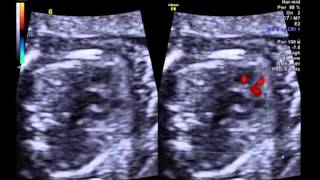 Tetralogy of Fallot with pulmonary atresia 3 vessel view [upl. by Sotsirhc]