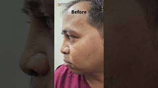 Rhinoplasty at Krisha Hospital [upl. by Morse]