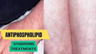 Antiphospholipid Syndrome Treatments [upl. by Elrae832]