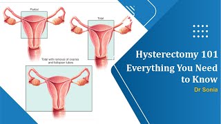 Hysterectomy 101 Everything You Need to Know Before and After the Procedure [upl. by Ardnohsed]