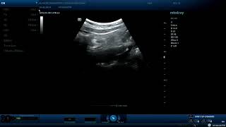 Appendicitis  ultrasound cases [upl. by Eerrehc]