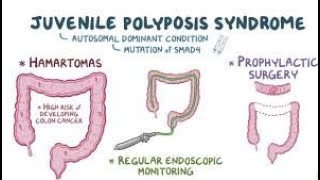 Juvenile Polyposis Syndrome [upl. by Chernow687]