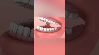 Wisdom tooth problem dentist teeth [upl. by Frerichs740]