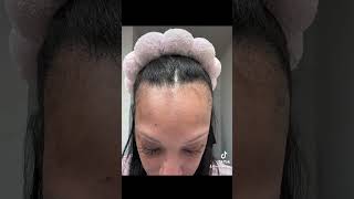 Hair Growth Journey using Minoxidil alopecia naturalhair minoxidil beforeandafter [upl. by Isacco]