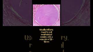 Follicular adenoma [upl. by Aleusnoc]