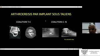 Le traitement chirurgical du pied plat chez l’enfant par arthroereisis [upl. by Leaffar]