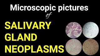 Microscopic pictures of salivary gland neoplasmsDr Poojireddy oral pathology [upl. by Biddle]