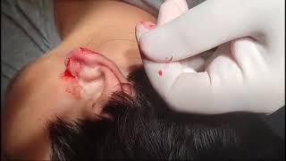 Foreign body removal from the ear [upl. by Anawak298]