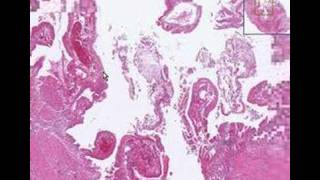 Histopathology GallbladderAcute cholecystitis [upl. by Sassan]