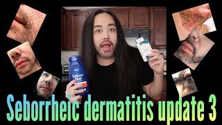 Seborrheic Dermatitis  Update 3 [upl. by Brosy]