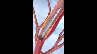 Coronary Angioplasty and Stent Insertion animation shorts anatomy science asmr [upl. by Uliram]