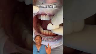 Replacing missing teeth with dental bridge dentalbridge missingteeth toothreplacement teethbits [upl. by Alyac989]