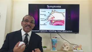 Septal perforation Hindi Patient teaching programme [upl. by Reseta]