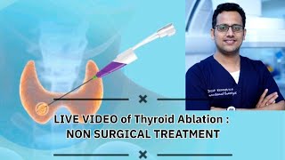 Live Video of Thyroid Ablation  Non Surgical treatment [upl. by Naman]