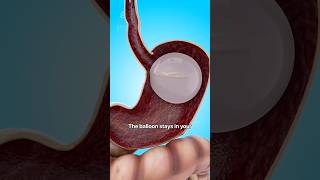 How a Gastric Balloon Helps with Weight Loss 😮  shorts viralvideo  Creativelearning3d [upl. by Furmark]