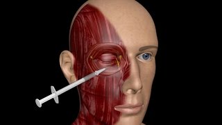 3D MEDICAL TRAINING PROGRAM  BLEPHAROSPASM TREATMENT [upl. by Aretak331]